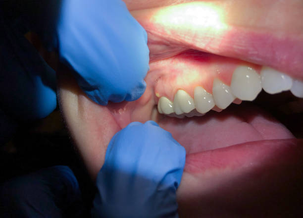 Best Emergency Wisdom Tooth Extraction in Cascade, ID